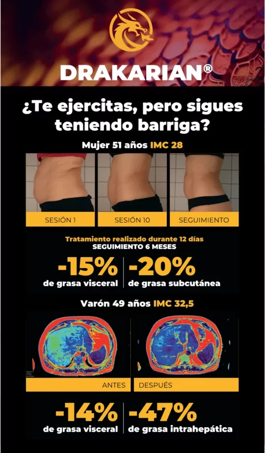 Infografía oficial Drakarian: resultados de mujer de 51 años (IMC 28) y varón de 49 años (IMC 32,5) con métricas validadas por resonancia magnética