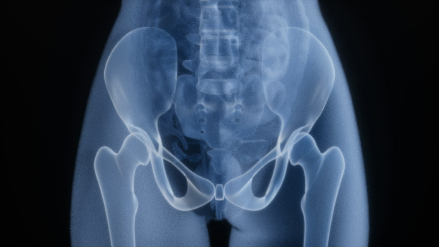 Radiografía de cadera y pelvis para valorar una coxartrosis o artrosis de cadera